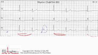 ECG Interpretation Tutorial  ChalkTalk 03  Advanced Level [upl. by Conway876]