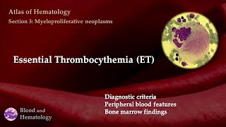 Essential Thrombocythemia ET [upl. by Notsnorb]