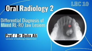 Oral Radiology 2  Lec 10  Differential Diagnosis of Mixed RL  RO Jaw Lesions [upl. by Alamac]