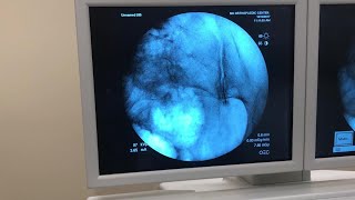 IntraArticular Injection of the Sacroiliac Joint Under Fluoroscopic Guidance [upl. by Koloski]