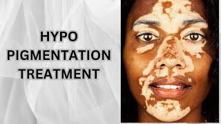 Treatment For Hypopigmentation From Lasers amp Scars [upl. by Amzaj]