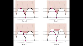 Papilla Reconstruction part 3 of 5 Classification of papilla loss [upl. by Narmis]