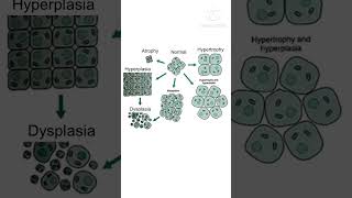 nursingmcq nursingcompetitiveexam nursingofficermcq cellular adaptation MetaplasiaDysplasia [upl. by Lanette]