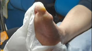 Pedicure Tutorial  Dead skin removal and Cracked heels treatment Callus removal from feet [upl. by Ahsayn]