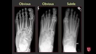 Tarsometatarsal Joints and Midfoot Lisfranc Sprains [upl. by Anilah795]