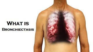 What is Bronchiectasis  Dr Technology [upl. by Kirst]