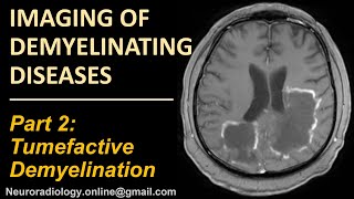 Imaging of Tumefactive Demyelination [upl. by Liartnod]