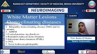 Imaging of white matter diseases normal myelination and demyelinating disease [upl. by Leanna]