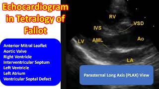 Echocardiogram in Tetralogy of Fallot [upl. by Clevie700]