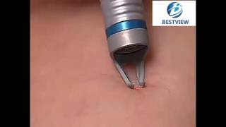 Spider Veins Removal Diode Laser BM980 [upl. by Lebanna]