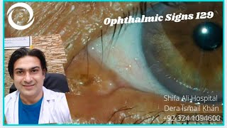 Ophthalmic Signs 129 [upl. by Iredale709]