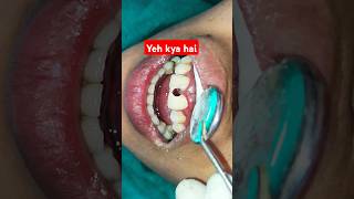 Dental Cavity in front teeth  dat kirale khayeko  Composite filling  Cosmetic treatment tooth [upl. by Ym]