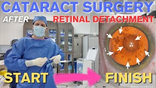 Cataract Surgery after Retinal Detachment  3 Min Polishing  Full Video from Start to Finish [upl. by Enirac721]