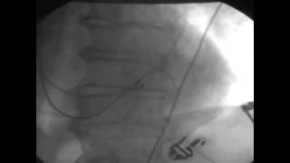 Placing a left ventricular lead over the wire into the coronary vein [upl. by Porter280]