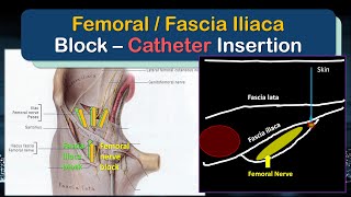 Femoral Nerve  Fascia Iliaca Block Catheter  A quotHowToquot Guide to Insertion [upl. by Eastman]