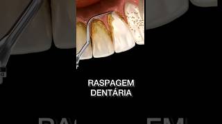 RASPAGEM DE DENTES raspagemdental raspagemdentaria oral bucal dentista dentistry periodontal [upl. by Dunkin148]