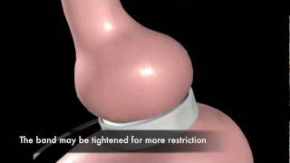 Laparoscopic Gastric Banding Animation [upl. by Aleihs]