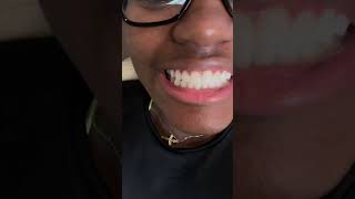 Getting new Invisalign attachments added [upl. by Ilil]