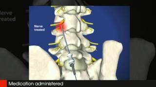 Lumbar Radio Frequency Neurotomy Tampa Pain Physicians 8139611314 [upl. by Nailij]