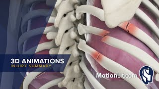 3D Animation Depicts Pneumothorax Injury In Police Abuse Case [upl. by Ott439]