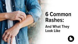 6 Common Rashes And What They Look Like  Healthline [upl. by Enala304]