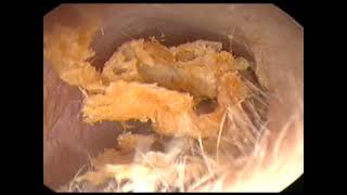 Gros bouchon de cérumen earwax removal Dr JB Danvin [upl. by Yesor532]