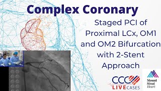 Staged PCI of Proximal LCx OM1 and OM2 Bifurcation with 2Stent Approach  November 2014 Webcast [upl. by Sackville]