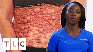 Doctor Treats One Of The Most Extensive Cases Of Neurofibromatosis She’s Ever Seen  Dr Mercy [upl. by Eseryt41]