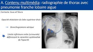 Item 154 Pneumopathie aigue communautaire [upl. by Eirdua989]