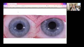 How to do an Iridology Assessment [upl. by Berkley127]