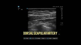 Dorsal scapular artery and nerve [upl. by Anerbas519]