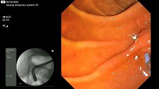 Bile leakage after cholecystectomy canulation with double guidewire technique [upl. by Mackintosh348]