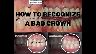 How To Recognize A Bad Dental Crown [upl. by Atinyl552]