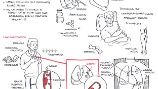 Pulmonary Embolism  Overview [upl. by Asselim]