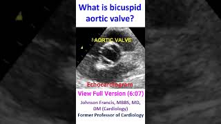 What is bicuspid aortic valve [upl. by Roxie]