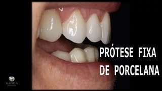 Prótese fixa de Porcelana com Implantes [upl. by Sheelah]