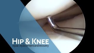 The Procedure  Arthroscopy [upl. by Ididn]