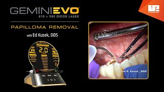 Papilloma Removal  Gemini™ EVO clinical cases [upl. by Donn102]