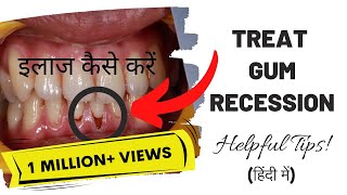 Treat Gum Recession  Symptoms  Causes [upl. by Romney]