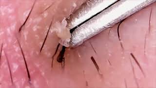 INGROWN HAIR Removal 😲 Infected Ingrown Hairs [upl. by Sulokcin399]