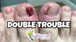 Double Trouble Ingrown Nail Ingrown Nail Removal [upl. by Marylin]