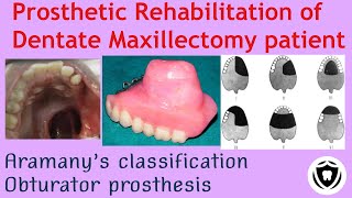 Prosthetic rehabilitation of Dentate Maxillectomy patientPart 1 [upl. by Giannini]