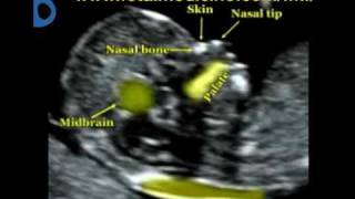 Fetal Medicine Foundation  Nuchal translucency [upl. by Neils133]