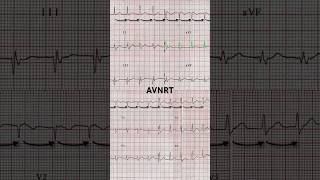 AVNRT ECG Narrow QRS complex [upl. by Yntruoc]