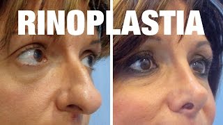 Rinoplastia Antes y Después  Tratamiento de Ana Isabel [upl. by Anauqes930]