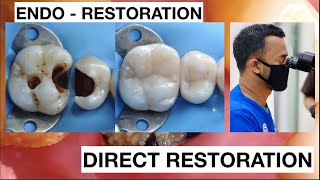 Dental Filling Procedure from Endodontic to Restoration Composite  General Dentist Griya RR [upl. by Deirdre878]