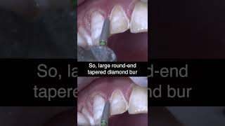 Prepping ANTERIOR Teeth with Enamel Hypoplasia  Ep 2 dentalshorts [upl. by Ykcor]