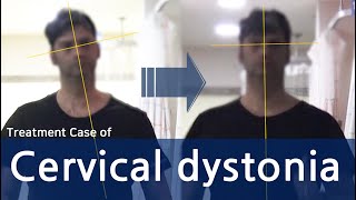 Dystonia  Cervical Dystonia  Spasmodic Torticollis  사경증 치료사례  근긴장이상증 [upl. by Rugen]