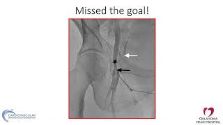 Femoral access stepbystep and troubleshooting  Mazen AbuFadel MD [upl. by Prinz]