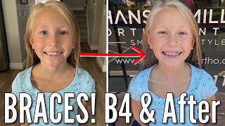 Shes Getting Braces  8 Year Old Goes to the Orthodontist to Get Braces Put On [upl. by Brownson]